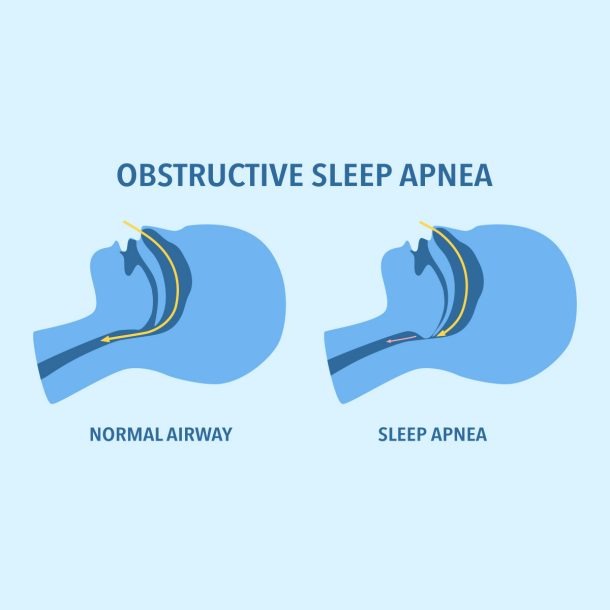 دستگاه ضد خروپف مدل CPAP کوچک